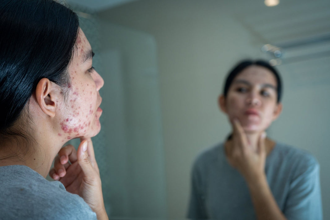 Comment se débarrasser de l’acné hormonale et retrouver une peau saine ? - VELUNA